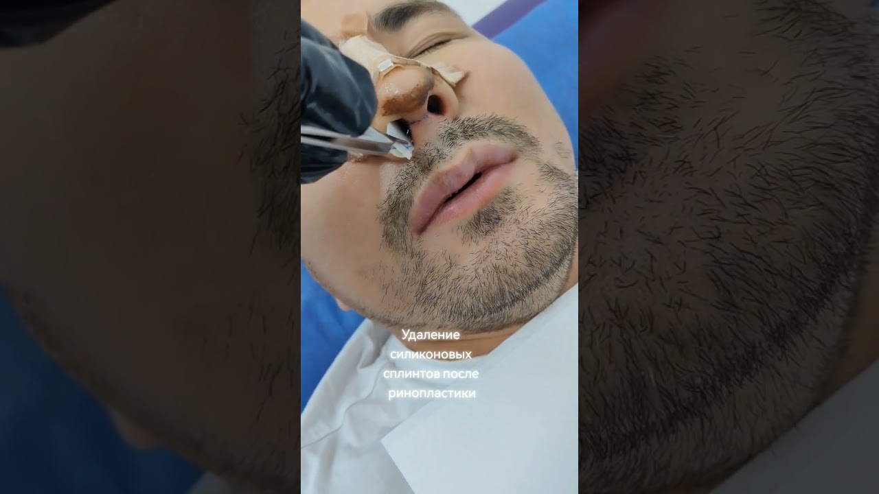 Силиконовый сплинт. Септопластика. Septoplasty