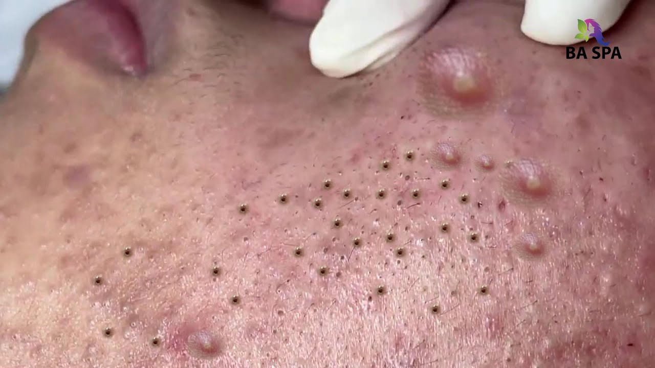 Relax Every Days With Spa 305 Popping Huge Blackheads Pimple Popping