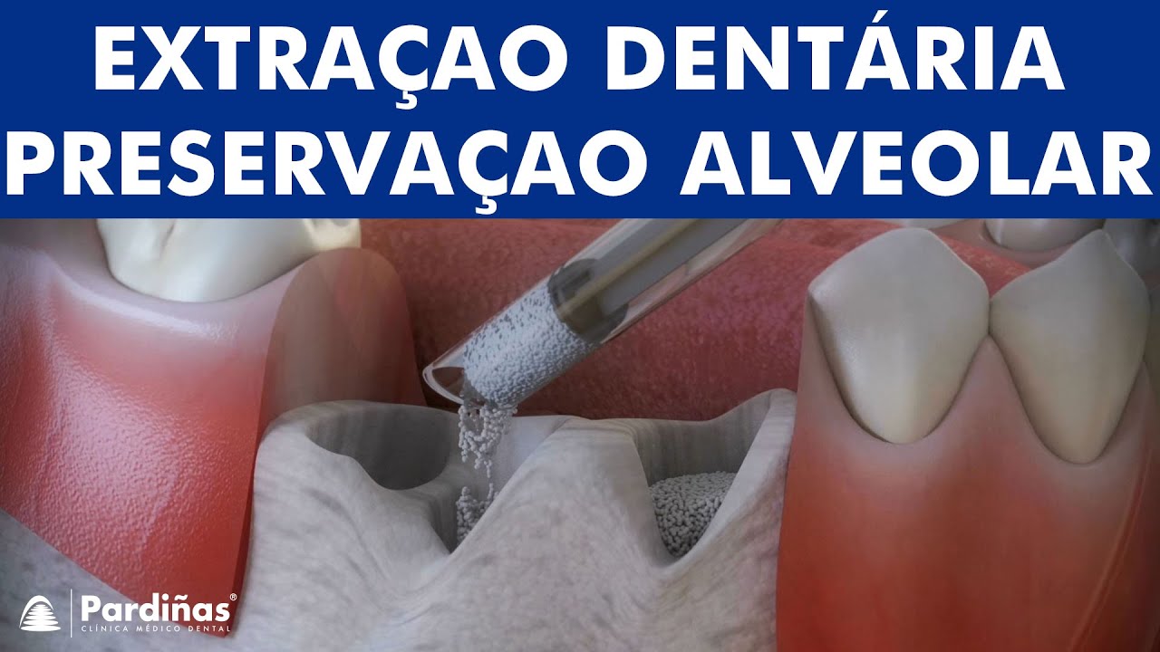 Preservação alveolar após a extração do dente ©