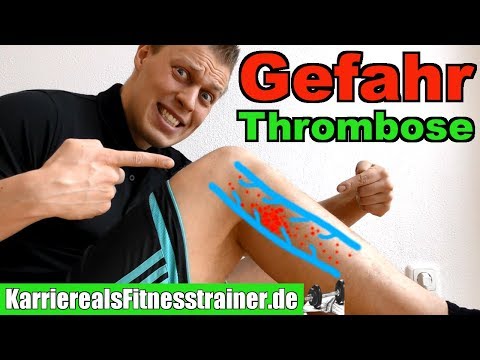 Thrombose: Symptome, Ursachen x Wie Sport Machen Alles Was Du Wissen Musst!