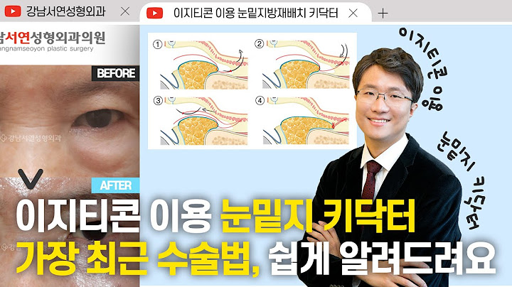 성형탐구 I  이지티콘 이용 눈밑지 키닥터 | 가장 최근 수술법, 쉽게 알려드려요