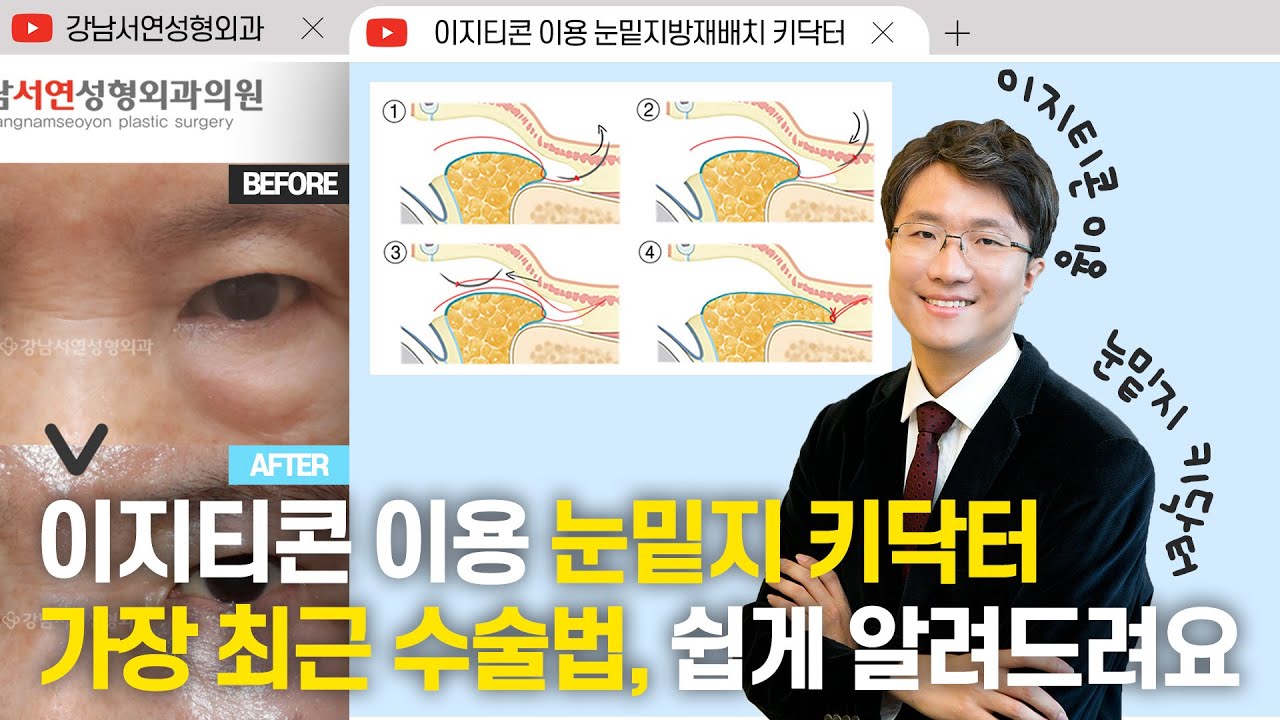 [Ганнам Соён Хуванцар Мэс Заслын Эмнэлэг] Хуванцар мэс заслыг судлах I | Изитикон ашиглан нүдний доорх өөхөн уутны мэс заслын түлхүүр эмч | Хамгийн сүүлийн үеийн мэс заслын