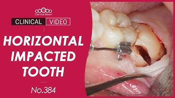 Extraction of a horizontally impacted tooth [Dr. Cho Yongseok]