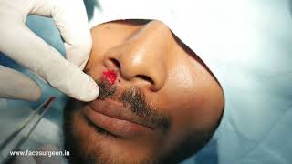 Lips laceration from accident sutured with fine rapide - Scarless treatment to prevent scar