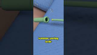 Damar Tikanikliği Ve Stent Yerleşi̇mi̇