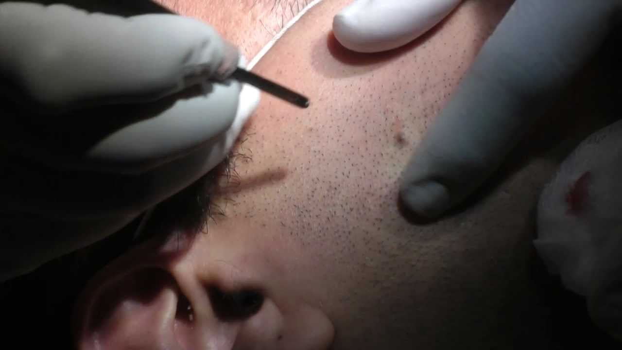 Nevus Removal by Laser Dr Reza Yazdanpanah, Malmö, Sweden, 2013 YouTube