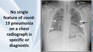 COVID-19: Explained What You See on Chest X-ray