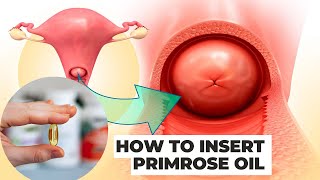 How to Insert Primrose Oil into the Cervix | Prepare for Labor Naturally screenshot 2
