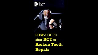 POST & CORE after RCT |Broken Tooth Repair Dr. Manesh Chandra Sharma| Doctors' Circle #shorts