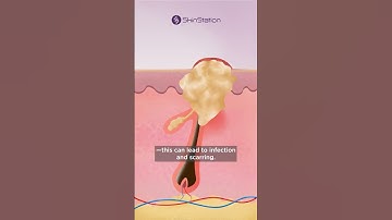 Thumbnail of A Permanent Solution to "Chicken Skin"  #laserhairremoval  #yourbestskin