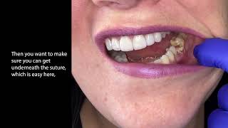 How to remove dental sutures. by Hygiene Edge 9,644 views 3 months ago 1 minute, 39 seconds