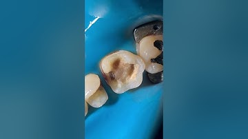 Teflon Application  for class II composite