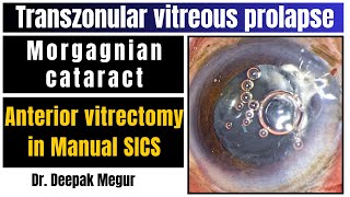 Anterior Vitrectomy In Manual Sics - Transazonular Vitreous Prolapse Dr Deepak Megur