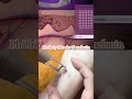 THÂM MỤN CHÂN tưởng bó tay... Ai ngờ hết chỉ sau 1 liệu trình!