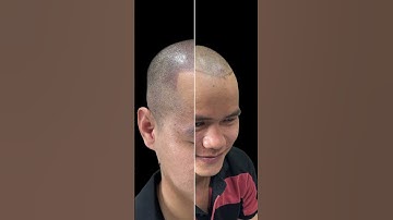 Xăm tóc hói, smp scalp vietnam hairtattoo #hairtattoo #tattoohead