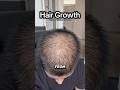Hair Growth