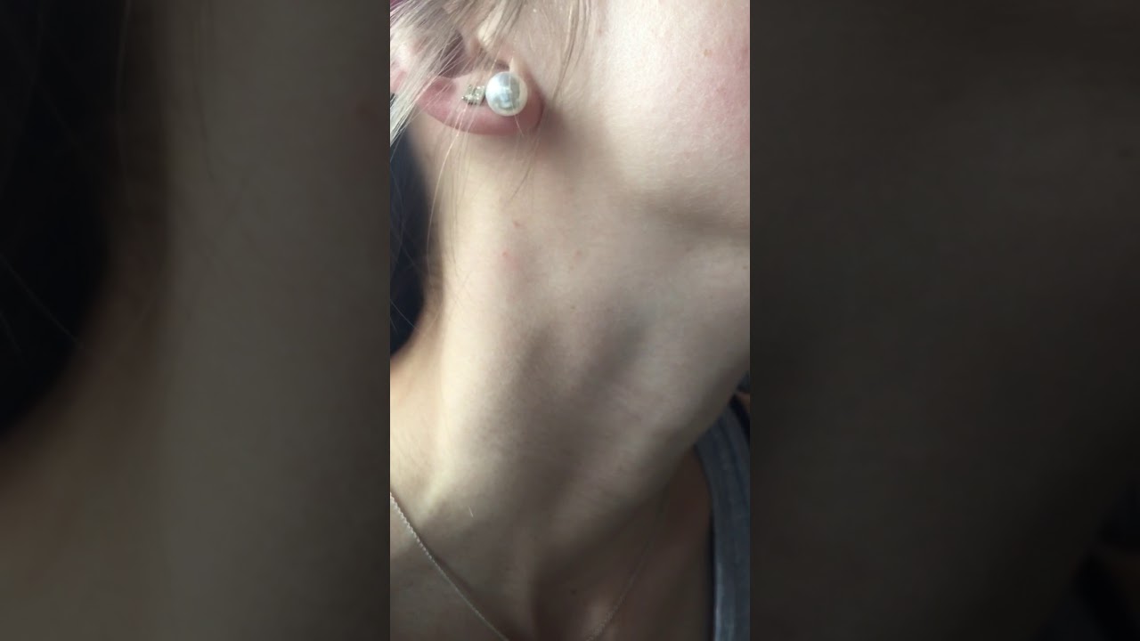 Johnson’s regional assessment #4 up close jugular pulsation