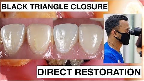 Black Triangle Closure Direct Bonding Composite Restoration | General Dentist Griya RR