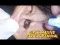 Girl's Massive Earwax Removal