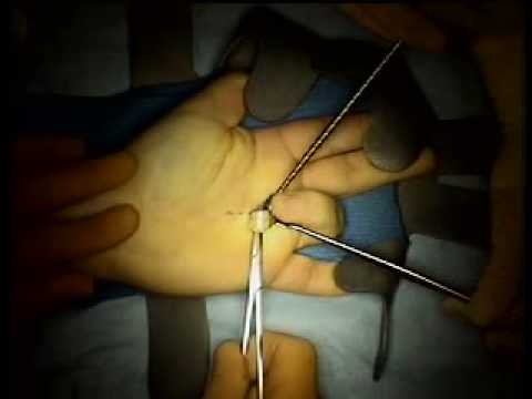 Trigger Finger Surgery: inside the operating room