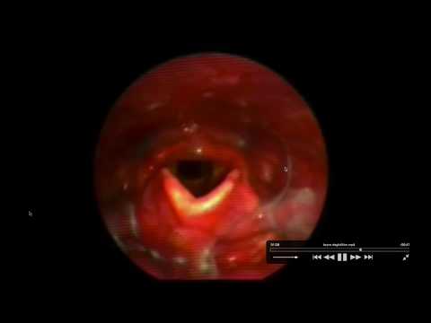 4b Larynx déglutition