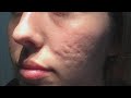 Does This New Procedure Clear up Acne Scars?