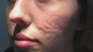 Does acne scarring get worse with age?