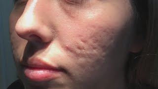 Does This New Procedure Clear up Acne Scars?