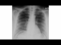chilaiditis - is that free air under the diaphragm?