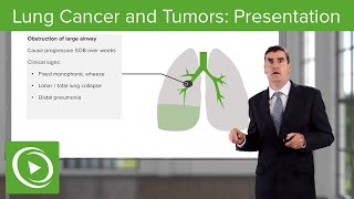 Lung Cancer and Tumors: Presentation – Respiratory Medicine  | Lecturio