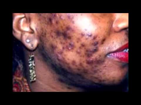 Acne vulgaris