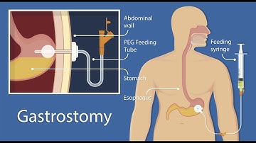 Closure of Gastrostomy CPT code - simplify medical coding