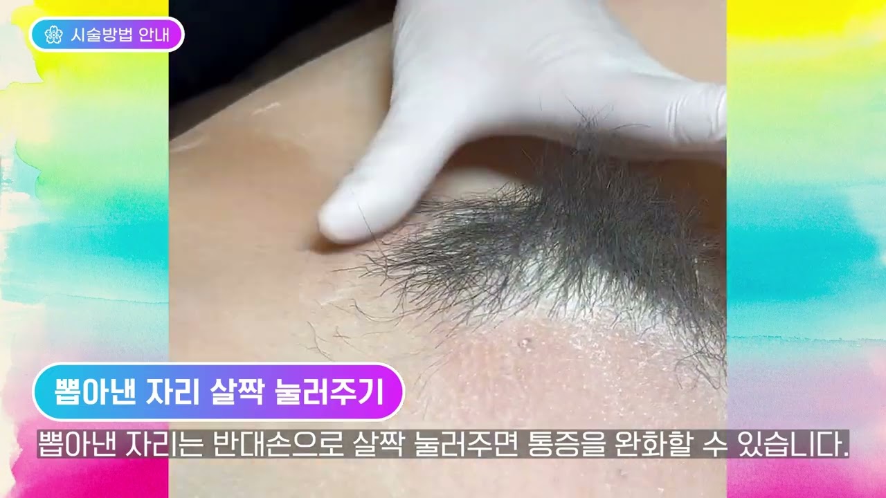 비에라 버니 슈가링 여자 브라질리언왁싱 시술방법