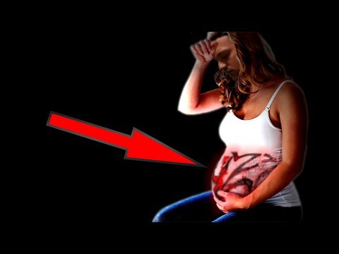 Video: Endometriosi Mirena: Aiuta O Fa Male?