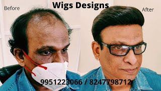 Non Surgical Hair Replacement in Bangalore | Hyderabad | 8247798712 | 9951223066