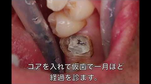 MTAでの根管充填　Root canal filling with Pro Root MTA White.