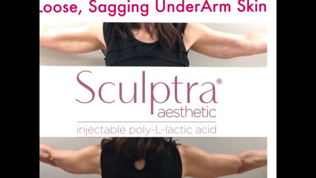 Get Firmer Arms with Sculptra and Get Rid of Batwings
