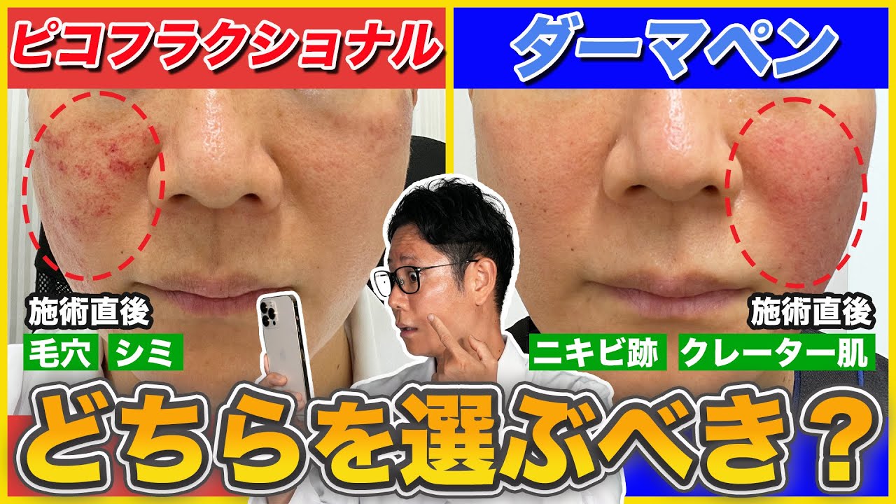 【毛穴/ニキビ跡】ダーマペンとピコフラクショナルレーザーのどちらを選ぶべき？