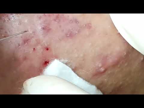Video Điều trị mụn hiệu quả tại TPHCM | HHV Clinic | Hiền... - youtube
