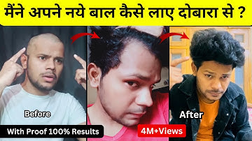 मैंने अपने बाल कैसे लाएं | My Hairfall & Hair Regrowth Real Story| With Proof |Dhru Rao