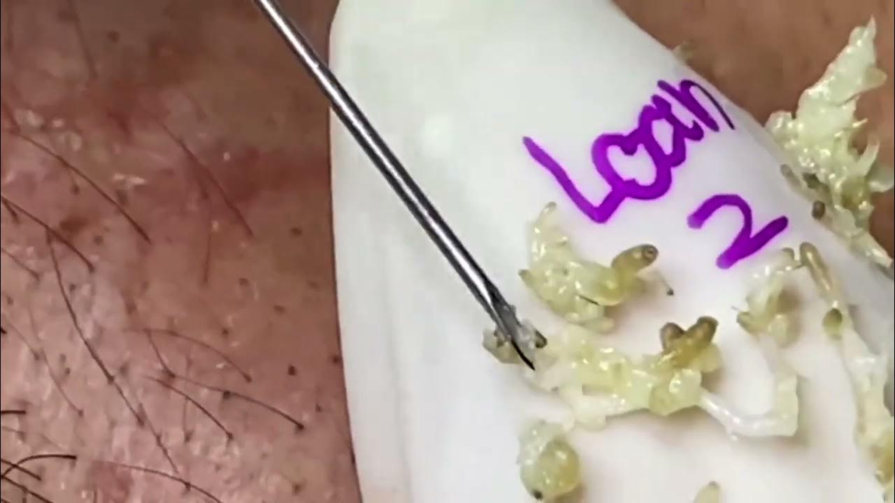 Extreme blackhead Removal at SRN Skin Care enilsa brown 1007 YouTube