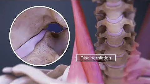 Animación de Espasmos en El Cuello