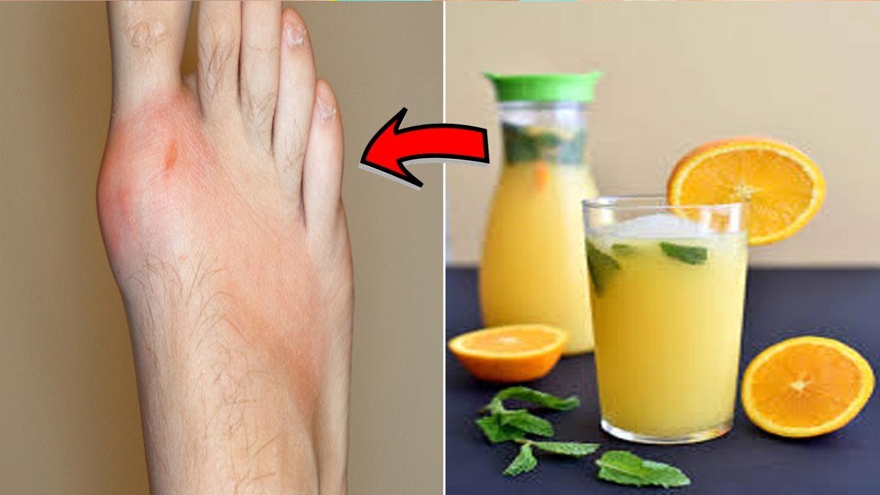 How To Relief Gout Pain Immediately In 20 Minutes Natural Remedies How to relief gout pain immediately in 20 minutes natural remedies