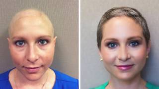 National Hair Loss - Chemotherapy Hair Loss & Regrowth