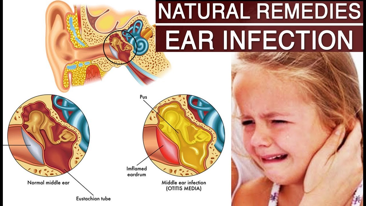 Best Home Remedies for Ear Infections and Earwax YouTube