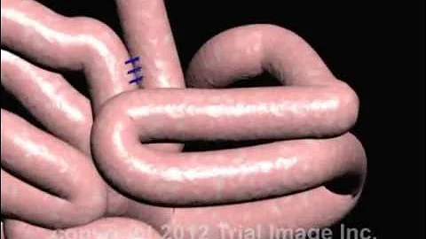 Intussusception of the Bowel video - Animation by Cal Shipley, M.D.