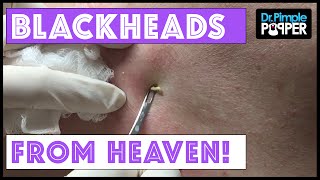 Back Blackheads from Heaven