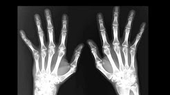 Radiographic Assessment of Arthritis