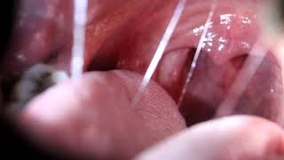 Asmr Moist Uvula Exam