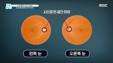 [기분 좋은 날] 눈 상태 알아보는 ＜안저 검사＞ 20200702